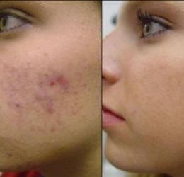 acne, dermatologo, viterbo