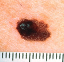 melanoma, tumori della pelle, viterbo